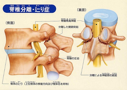 腰痛ベルト セール 椎骨分離